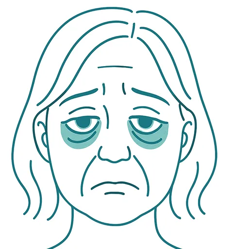 Woman with Dark Cicles Under Eyes