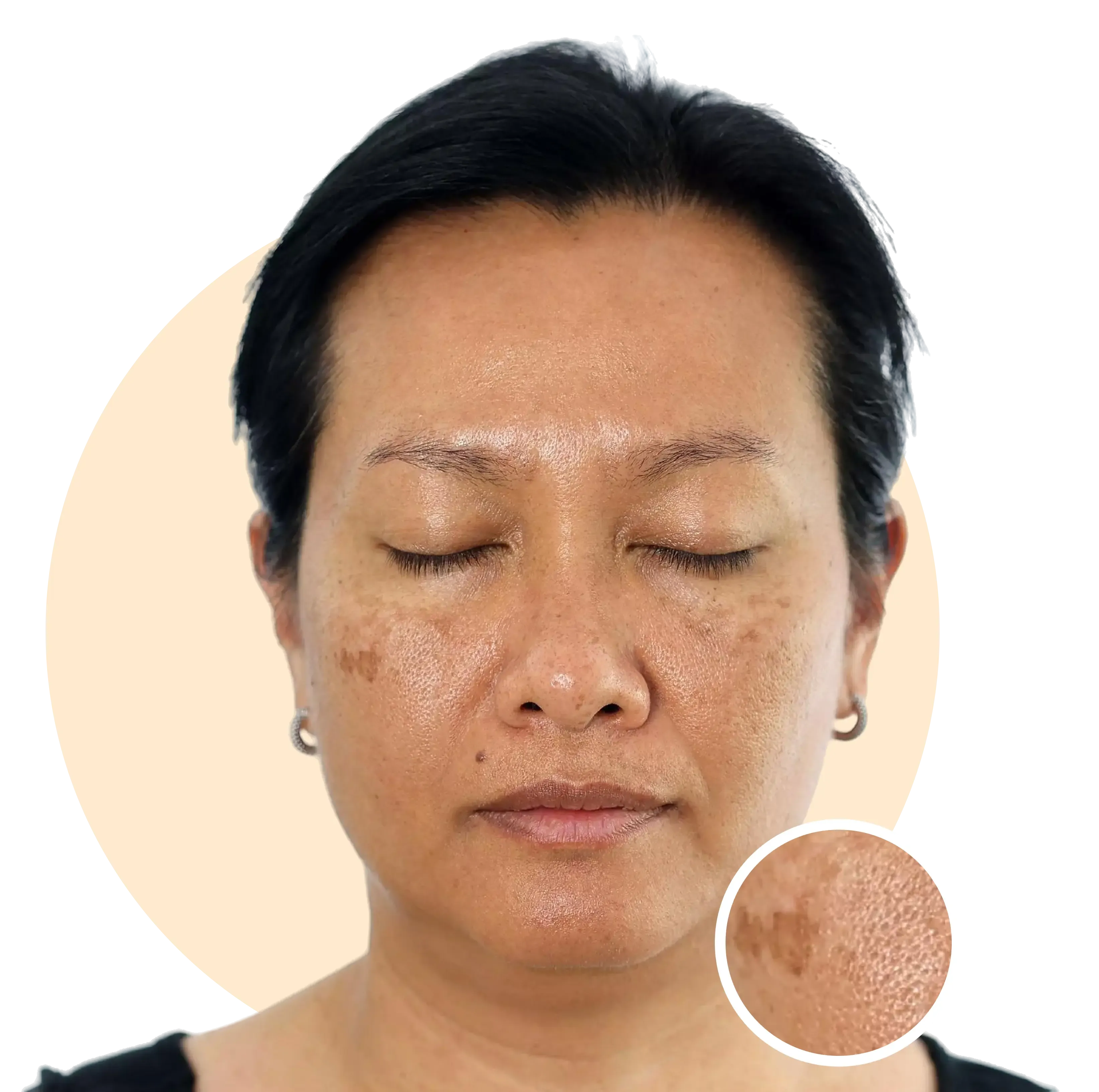 The Root Cause of Dark Spots