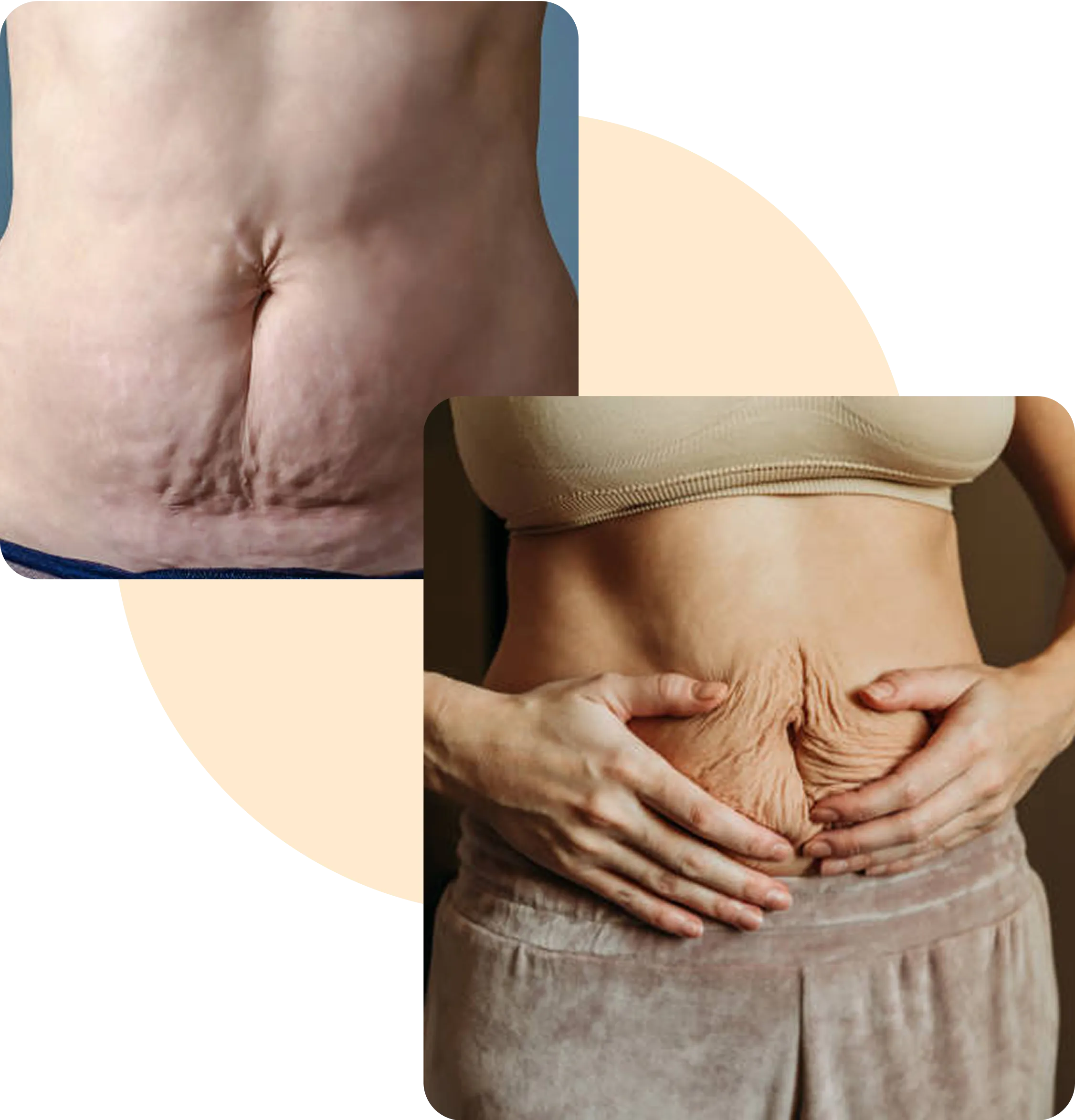 When Your Skin Locks Onto Fat Like Velcro…