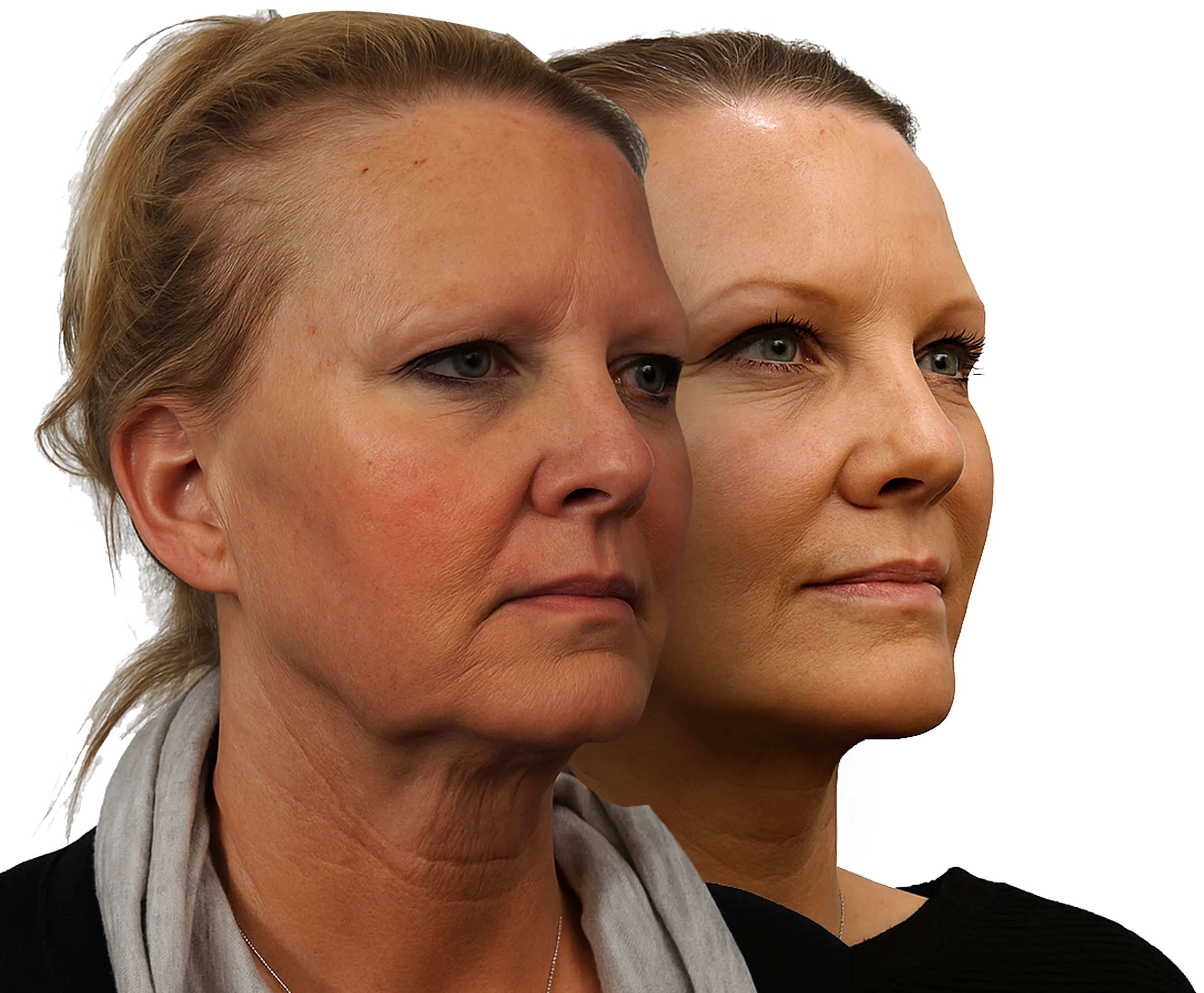 Elastase The Skin-Sagging Enzyme