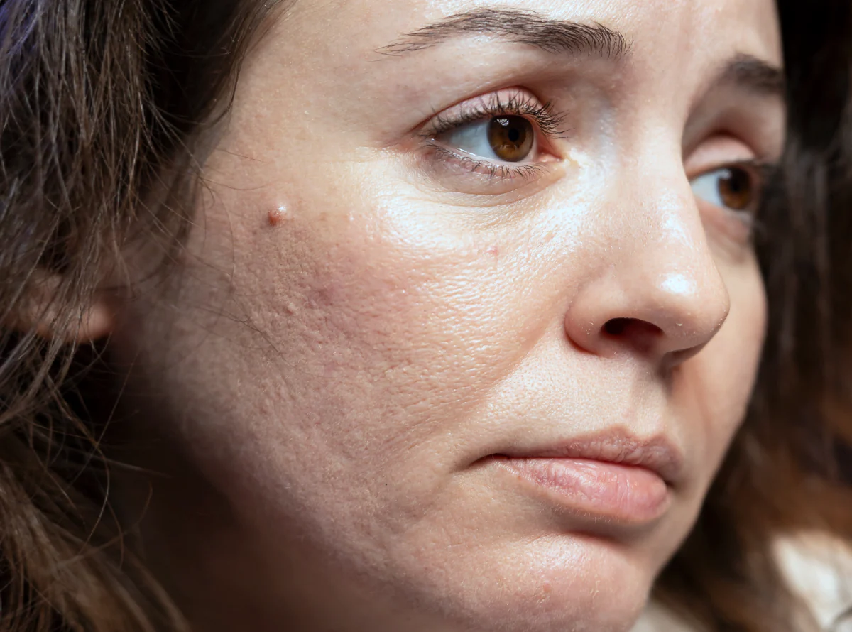 5 Ways Stress Shows Up On Your Skin